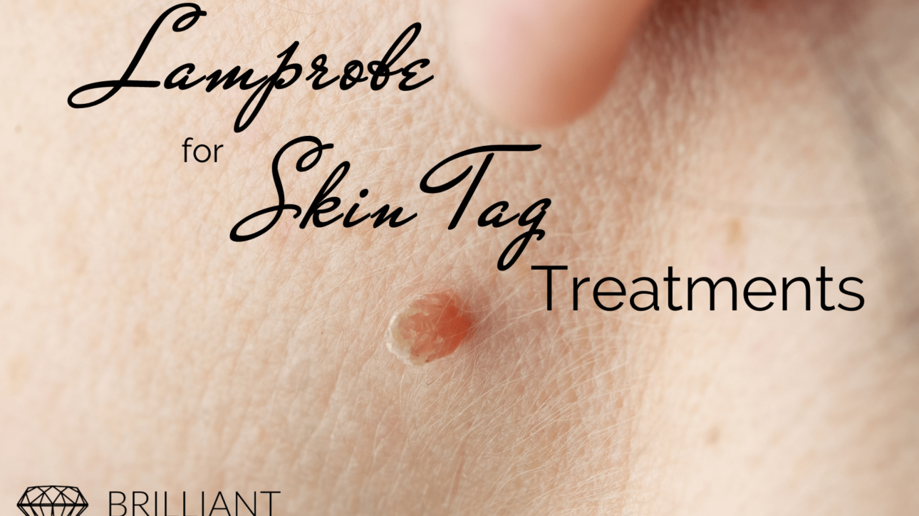 skin tag: text: lamprobe for skin tag treatments