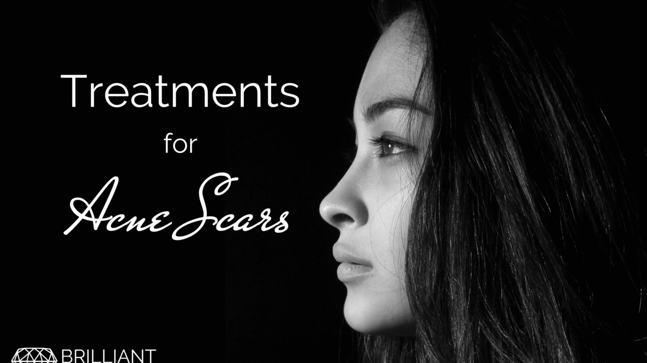 sideview of a teens face: text: Treatments for acne scar