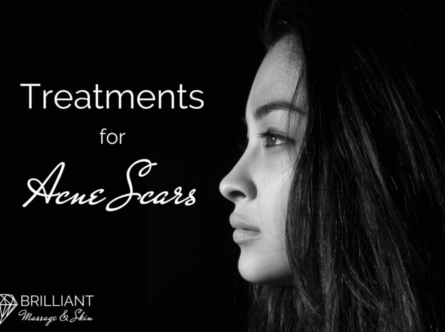 sideview of a teens face: text: Treatments for acne scar