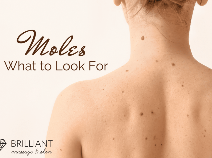 girl with moles on her back: text: moles- what to look for