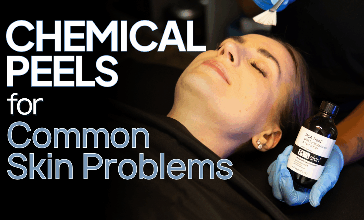A client having a chemical peel while the esthetician is holding a PCA chemical peel bottle: text: chemical peels for common skin problem